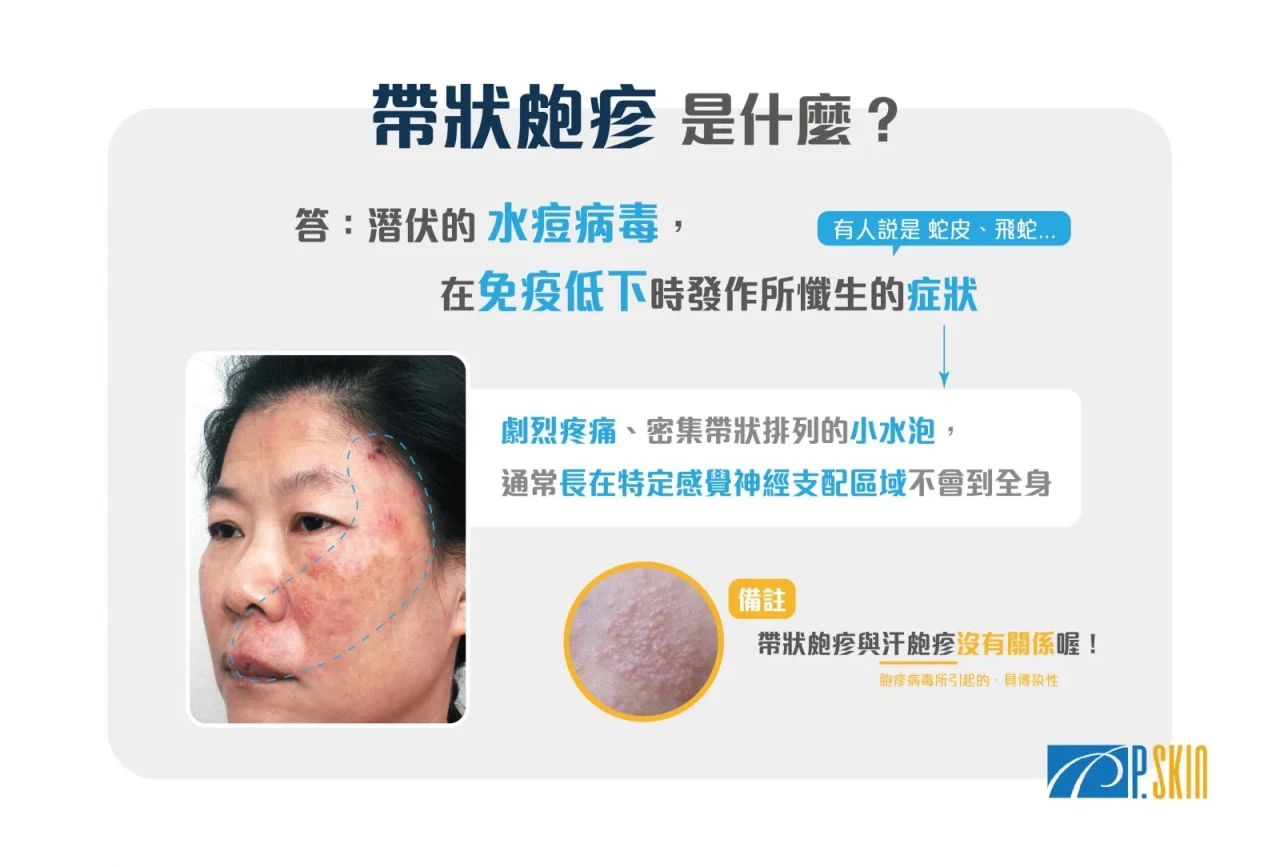 帶你了解【帶狀皰疹】 - 彭賢禮皮膚科診所