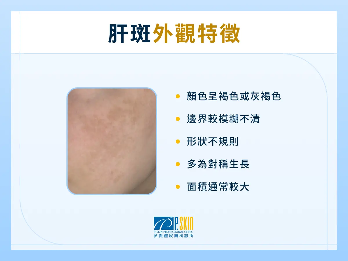 肝斑外觀特徵