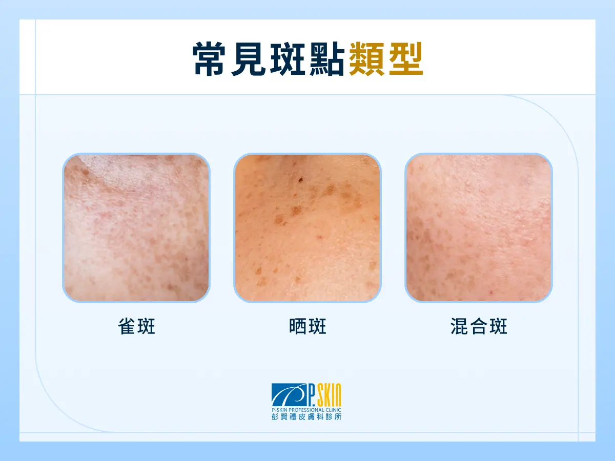 常見斑點類型