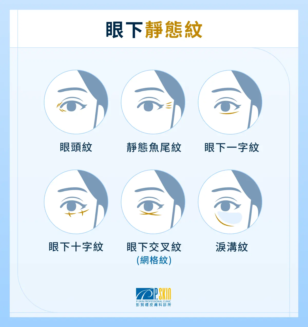 眼下靜態紋