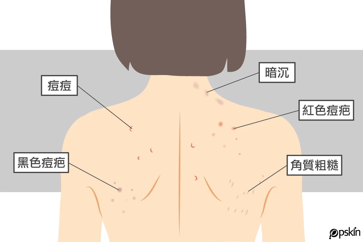 【高雄美背療程】背上的痘痘可以做什麼醫美改善? - 彭賢禮皮膚科診所
