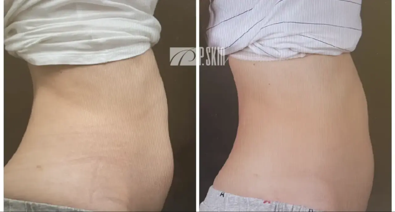 冷凍減脂案例:患者 B 腹部與腰側療程前後對比
