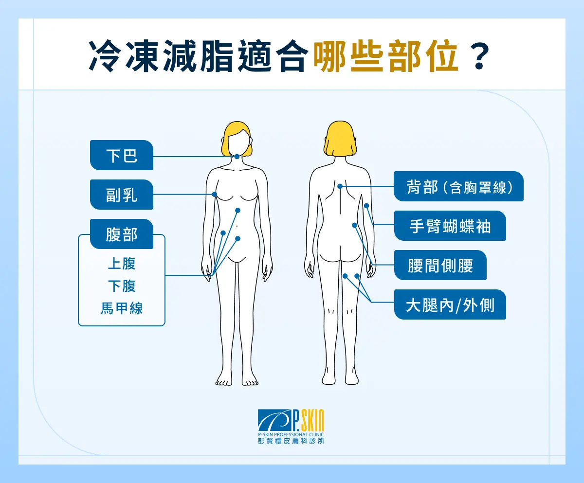 冷凍減脂適合哪些部位?