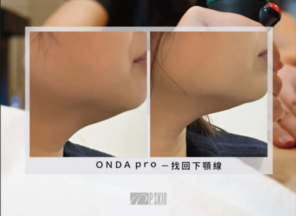 onda臨床應用