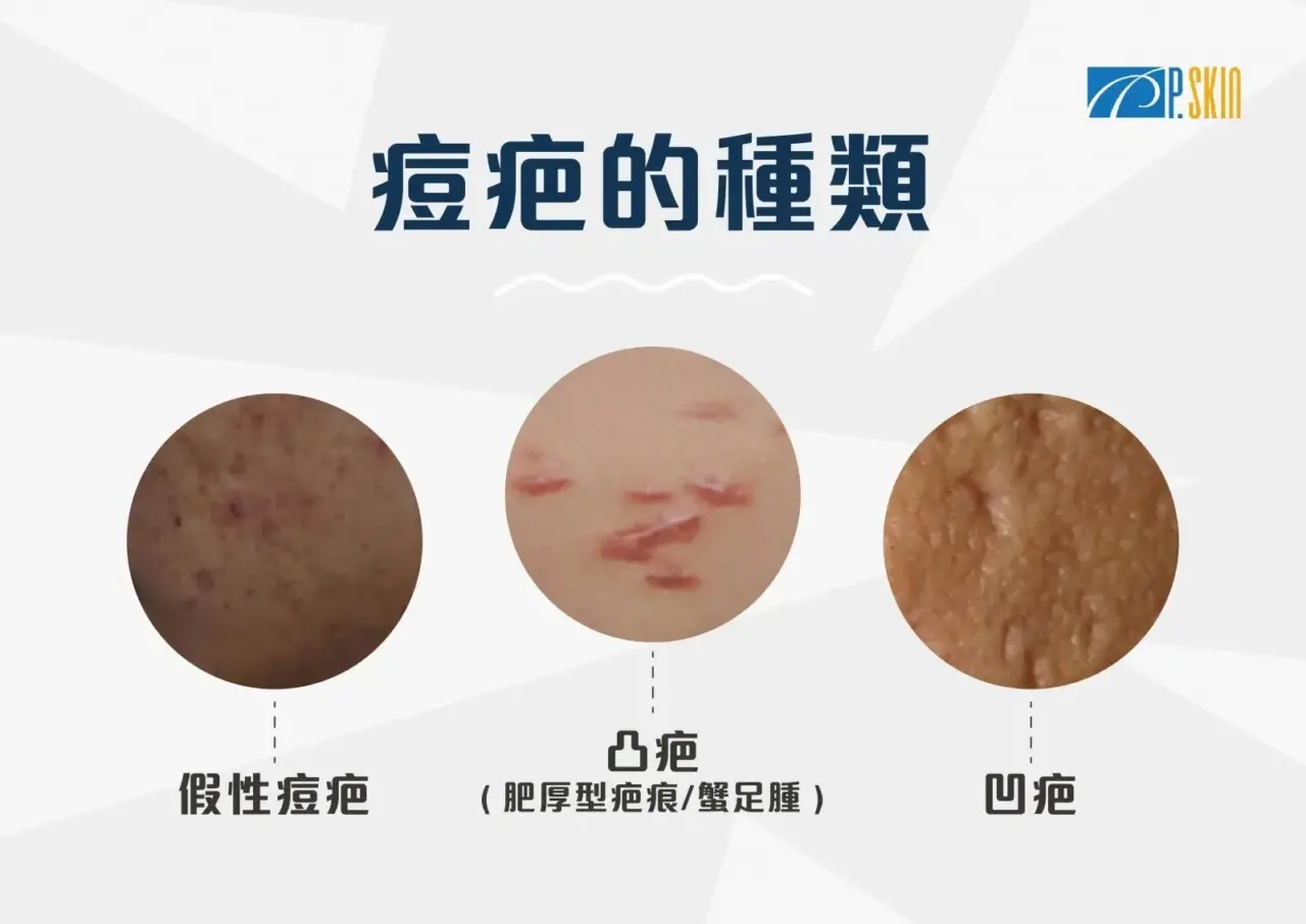 3 大痘疤種類