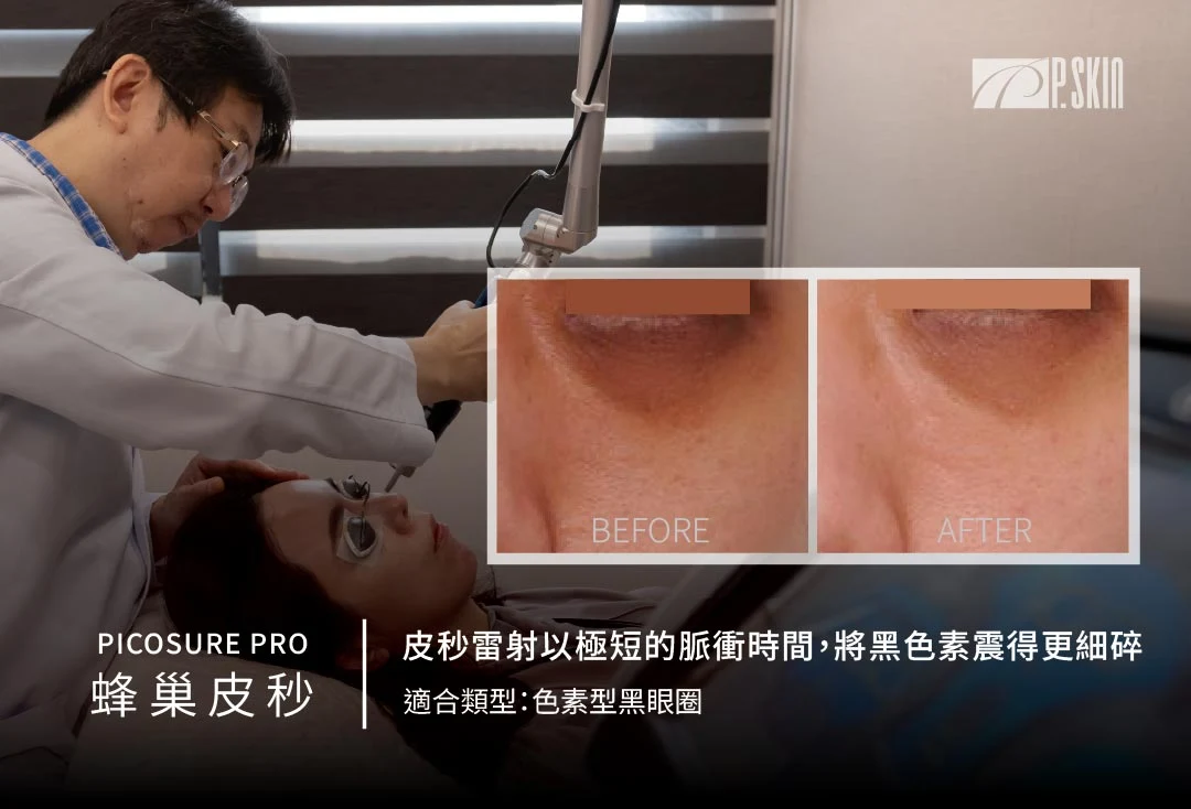 皮秒雷射改善色素型黑眼圈與眼周暗沉
