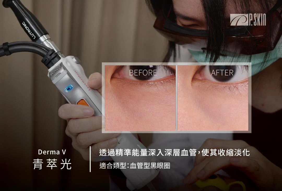 青萃光雷射改善血管型黑眼圈與眼下暗沉