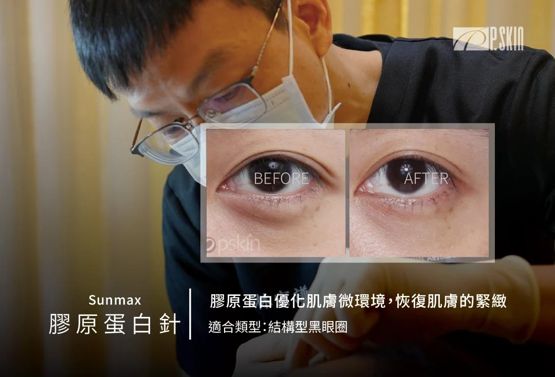 熊貓針改善結構型眼下陰影