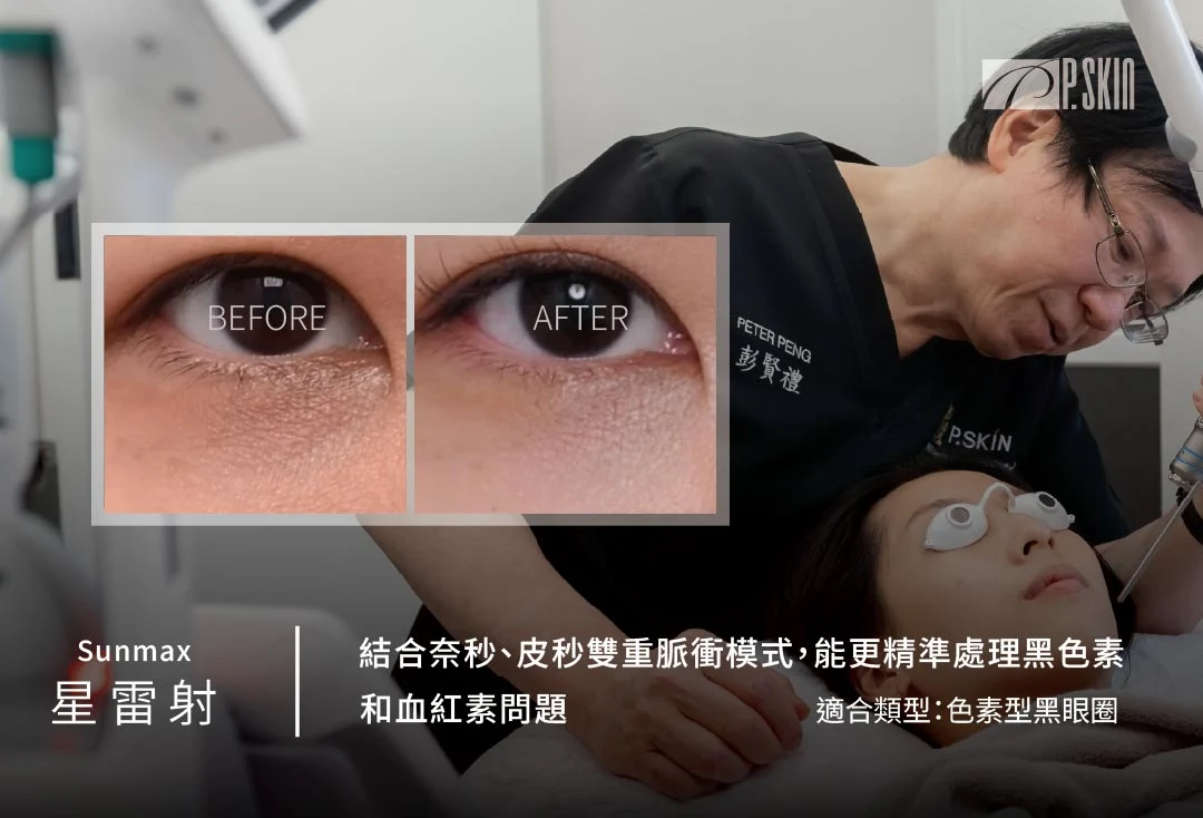 星雷射治療提亮眼周膚色