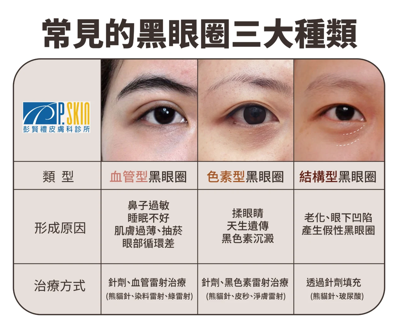 眼周暗沉類型解析:色素型、血管型、結構型